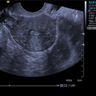 Фото: УЗИ малого таза при бесплодии